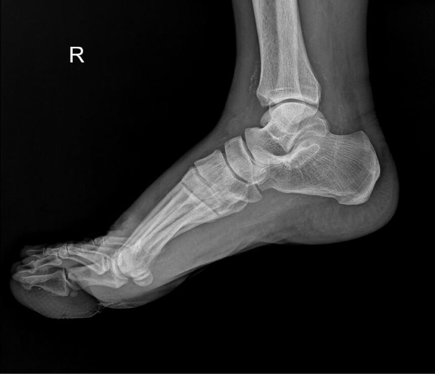 Foot and Ankle Expert Witness, Orthopedic Expert Witness, Expert Testimony, Foot and Ankle Injury Expert